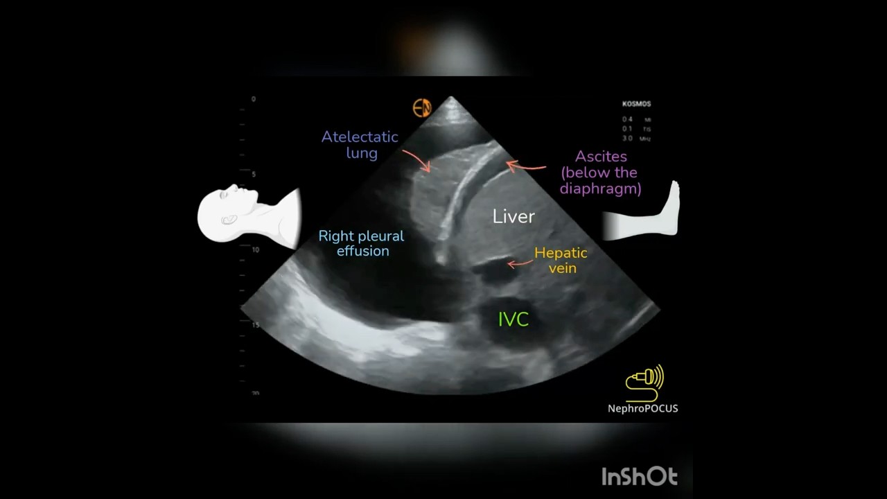 Pleural effusion on Ultrasound (POCUS) #pleuraleffusion