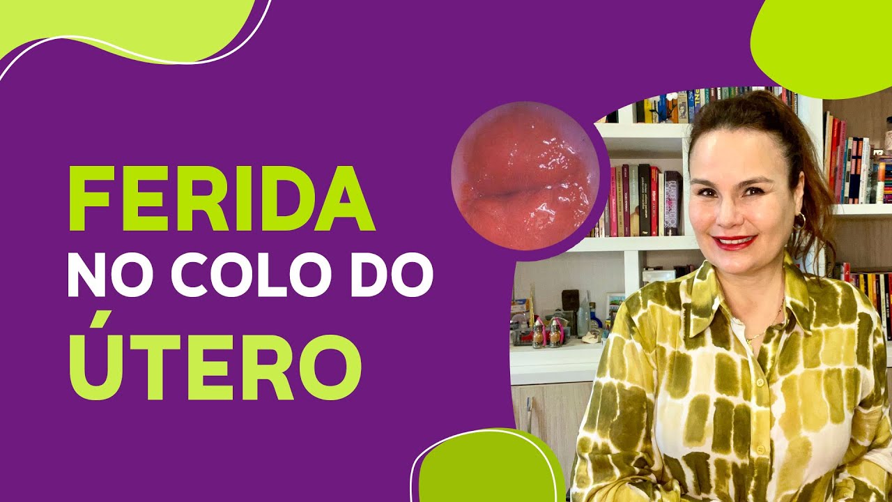 Ectr&oacute;pio - A ferida no colo do &uacute;tero