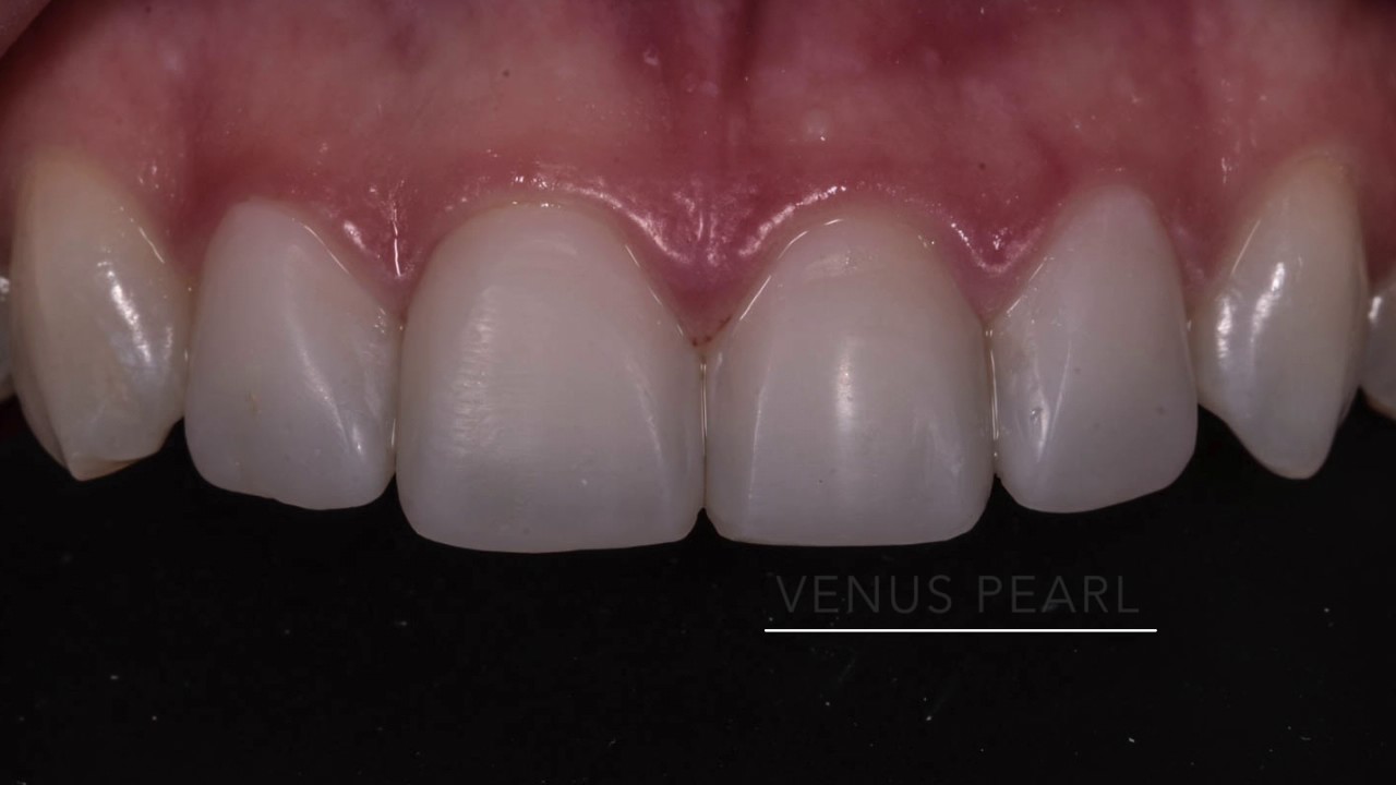 Composite Veneers