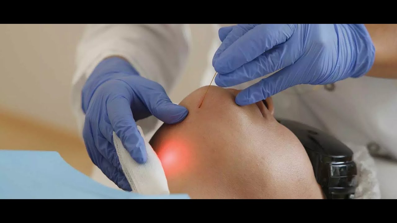 Endolift : Traiter le Relâchement Cutané sans Chirurgie- Clinique ReGeneva