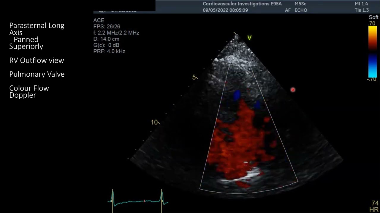 Standard TTE Protocol