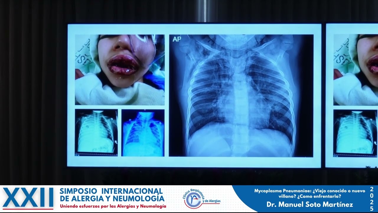 Mycoplasma Pneumoniae: ¿Viejo conocido o nuevo villano? ¿Como enfrentarlo?