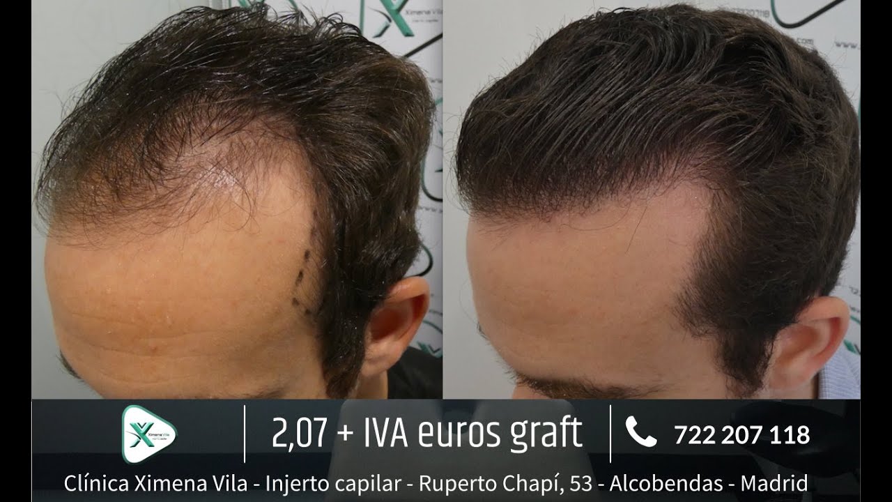 Trasplante capilar FUE - Dra. Ximena Vila - 2801 Grafts