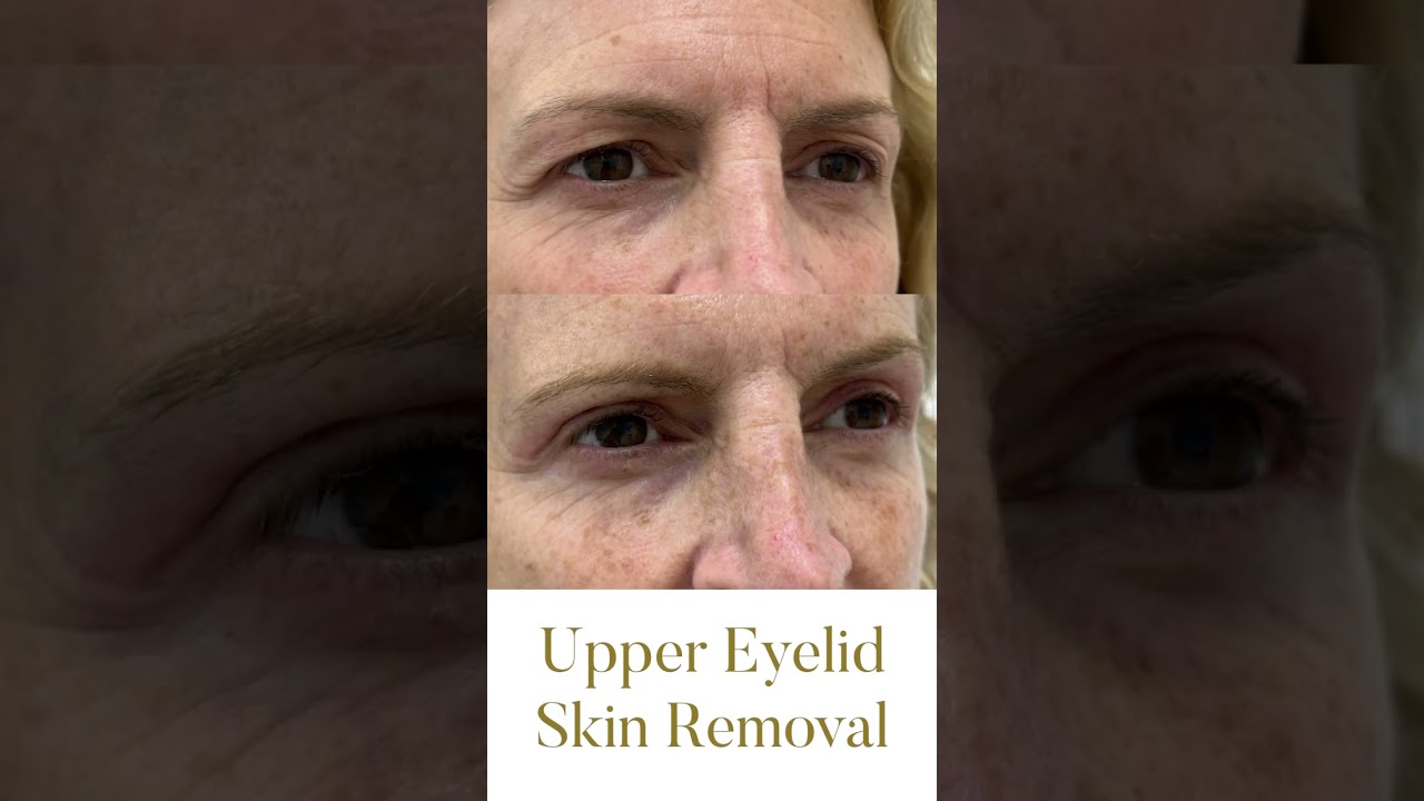 Upper Eyelid Skin Removal - Before & After 😍