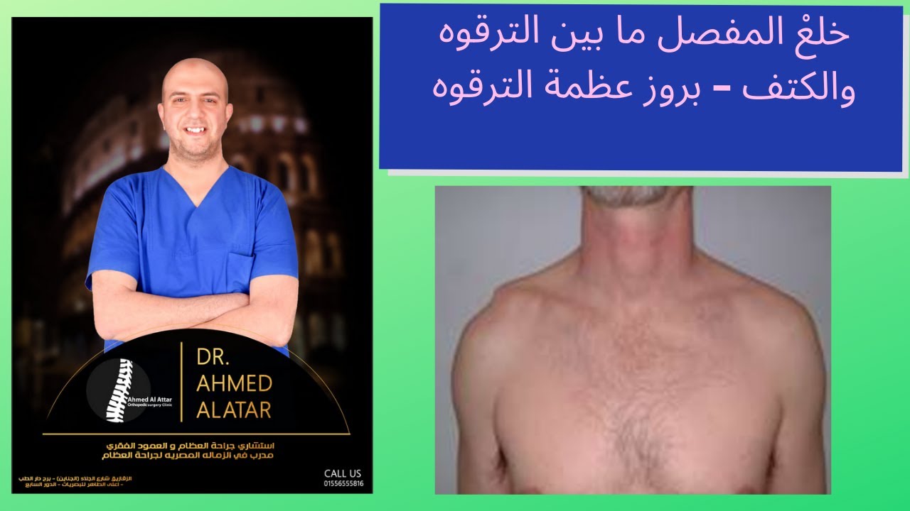 خلعْ المفصل ما بين الترقوه والكتف – بروز عظمة الترقوه