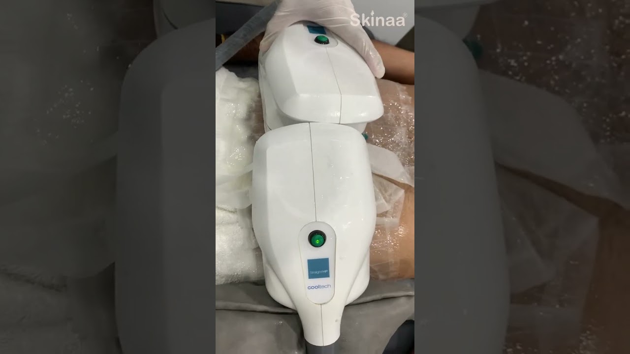 Fat Freezing Treatment at Skinaa Clinic | Achieve Your Dream Body with Advanced Technology 