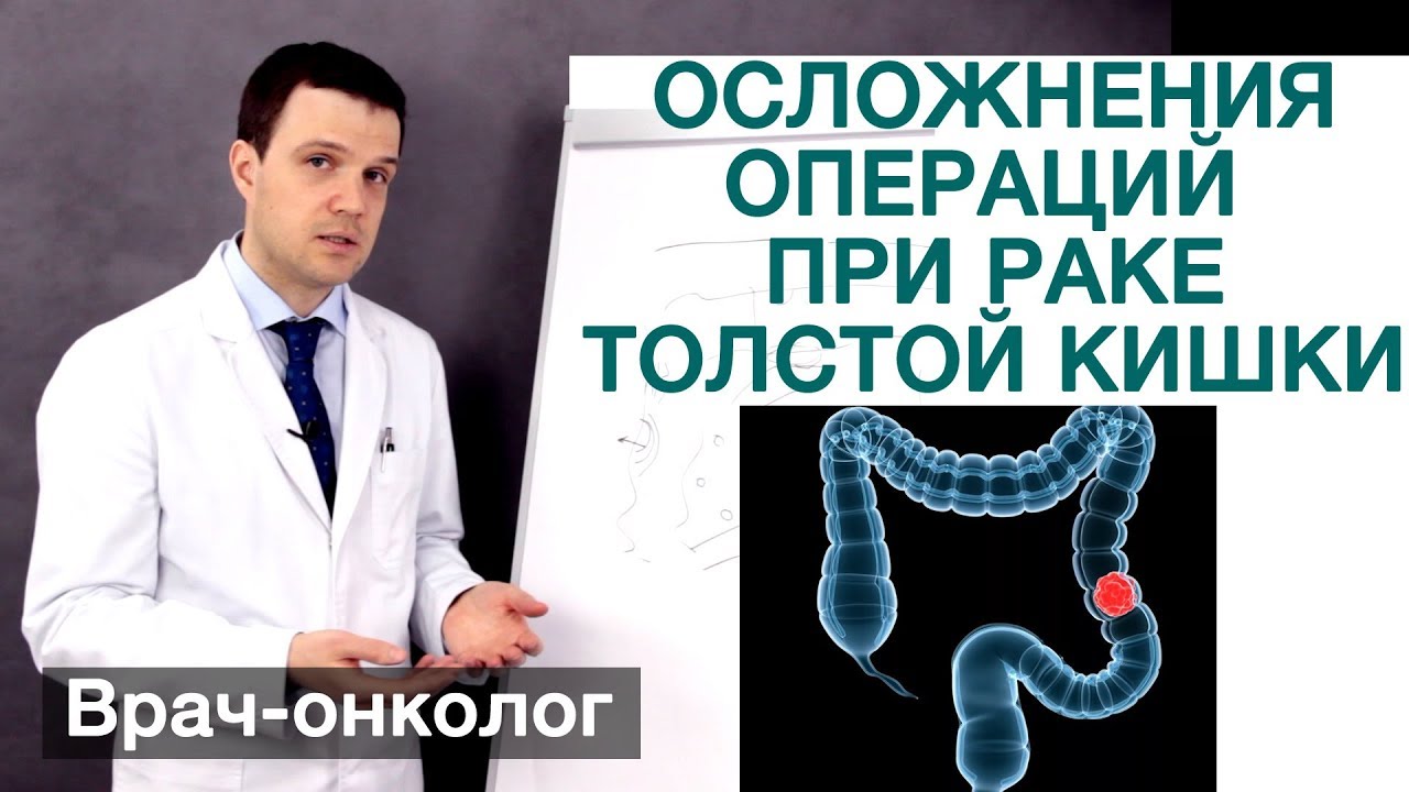 Рак толстой кишки. Осложнения операций - дефект швов после операции при раке толстой кишки