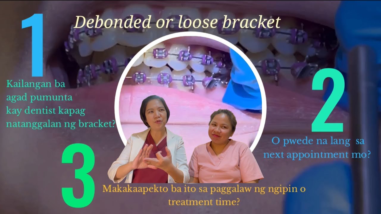BRACES PROBLEMS AND CONCERNS: Sa braces journey mo, naranasan mo na bang matanggalan ng bracket?