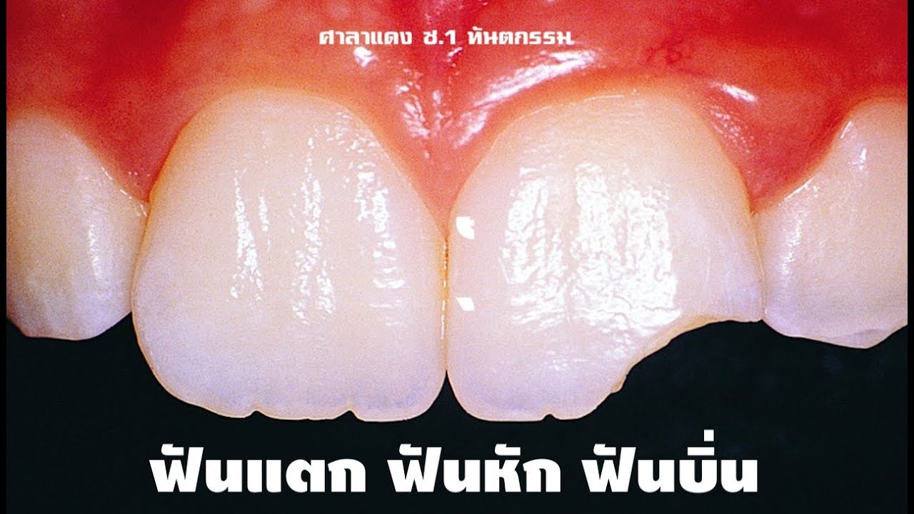 ฟันหัก ฟันบิ่น ฟันแตก อุดฟัน