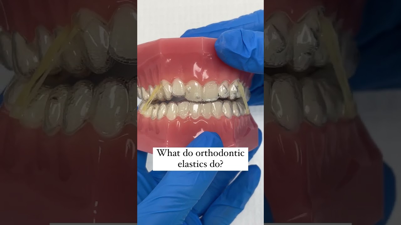Maria shows how orthodontic elastics can be used during clear aligner treatment