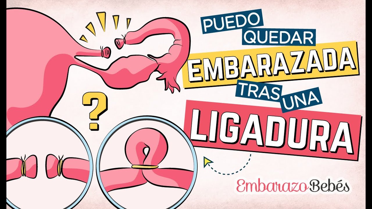 Con una LIGADURA de TROMPAS ✂️😯 ¿Puedo Quedar EMBARAZADA? || Embarazo y Bebés