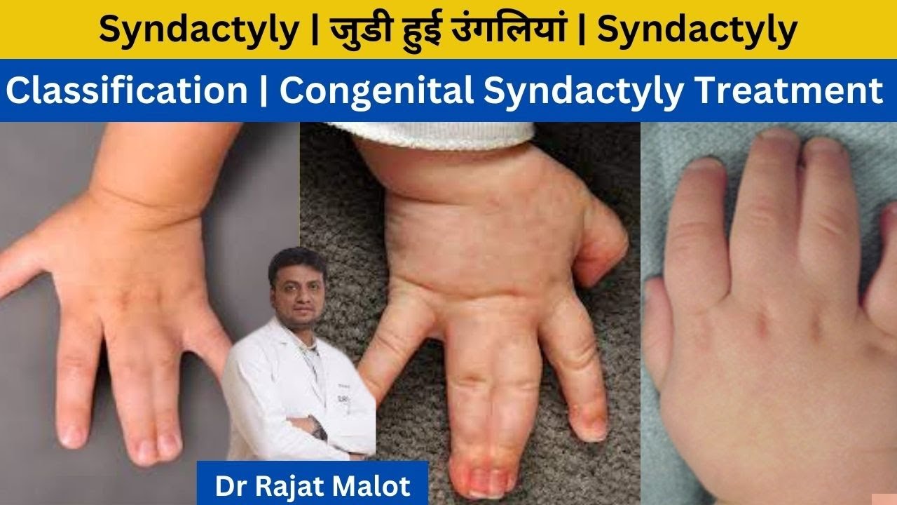 Syndactyly | जुडी हुई  उंगलियां | Syndactyly Classification | Congenital Syndactyly Treatment .