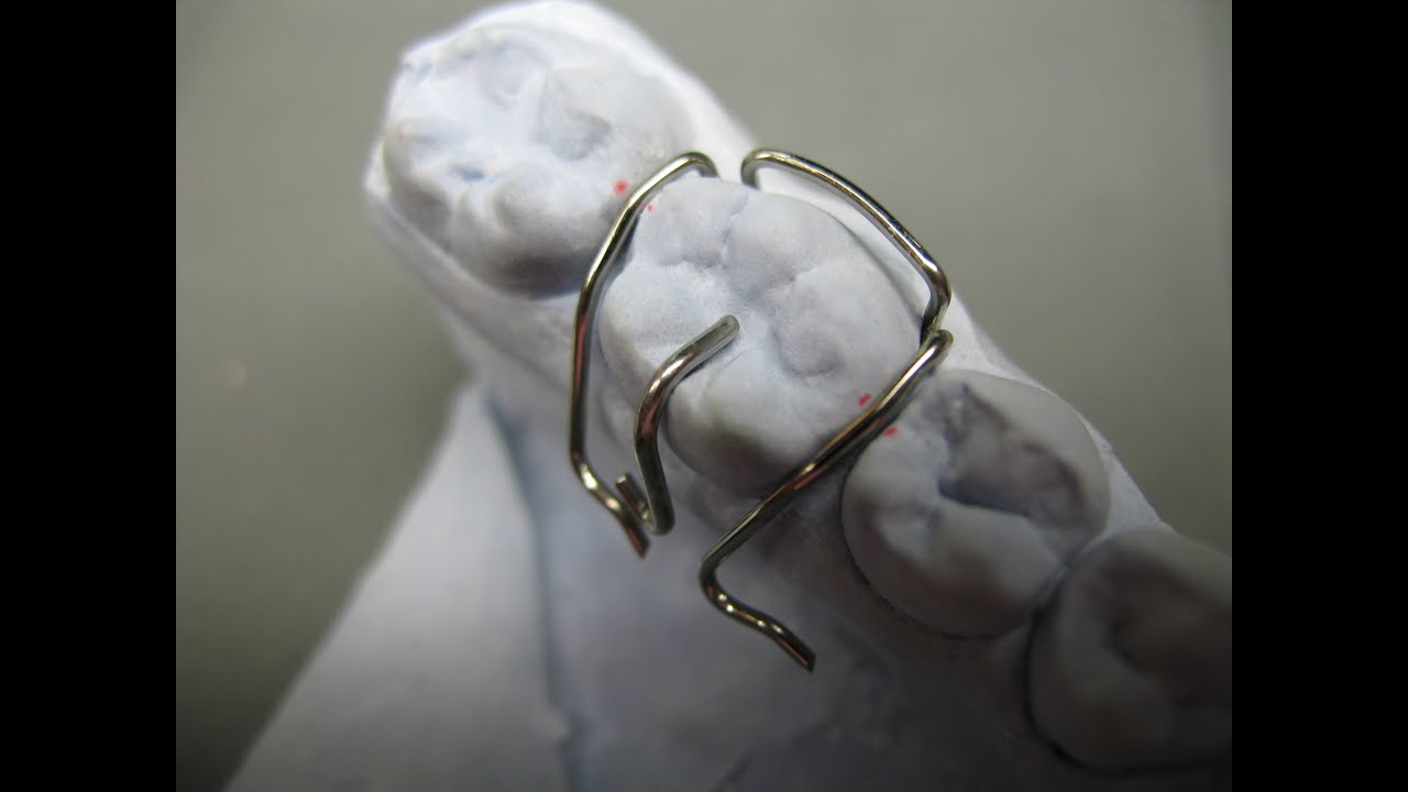 Adamsklammer Adams clasp KFO Kieferorthopädie Orthodontics