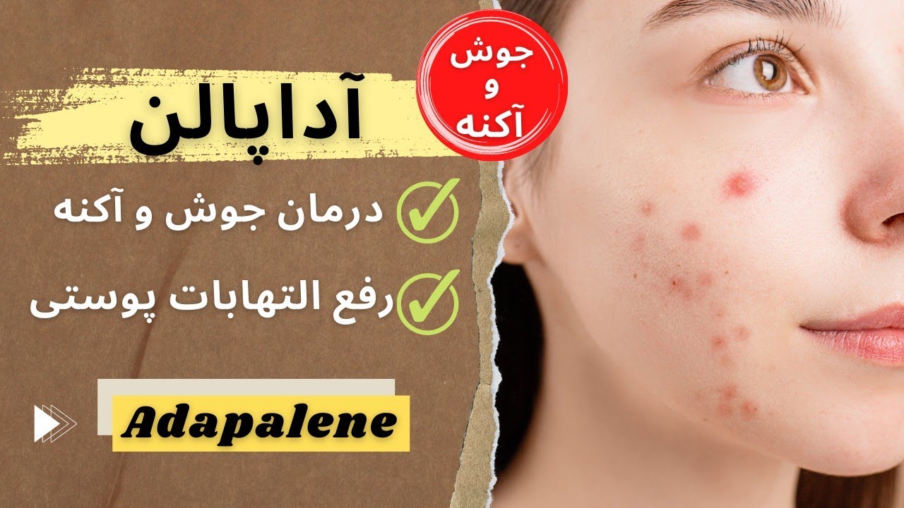 آداپالن موثر ترین دارو برای درمان جوش و آکنه