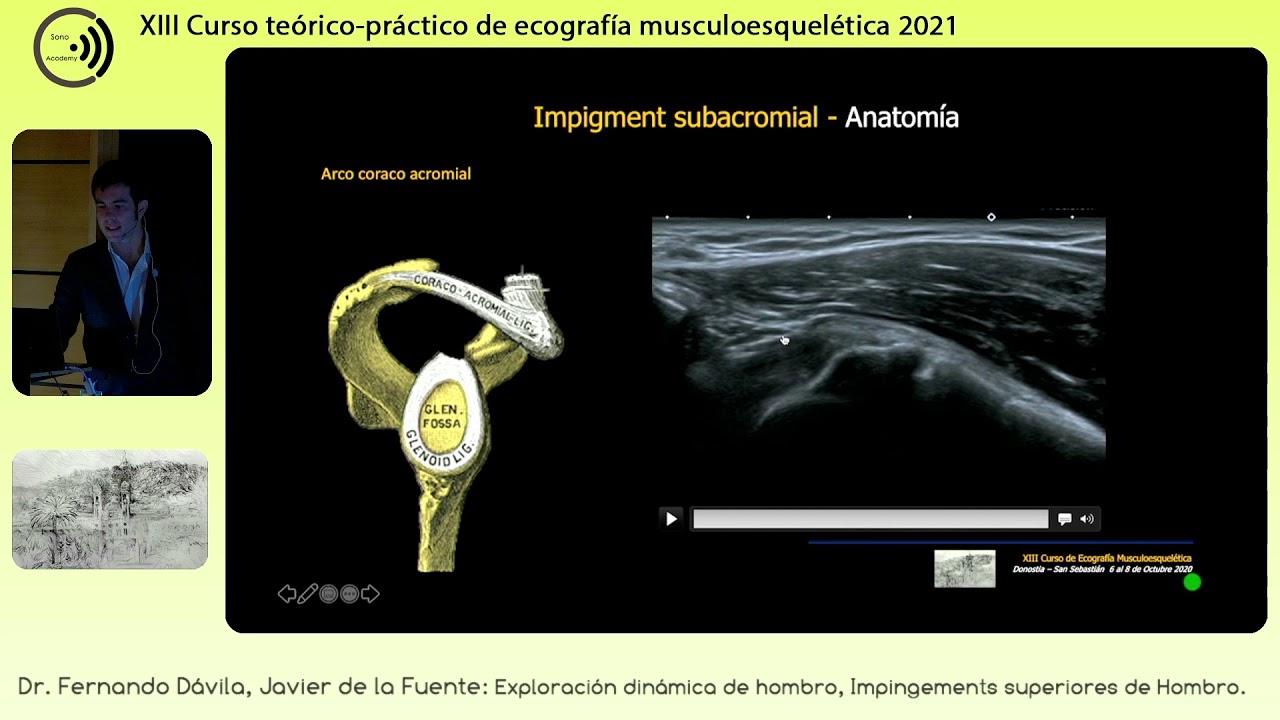 2021 Exploración ecográfica dinámica de hombro  Impingement superior  Fernando Dávila