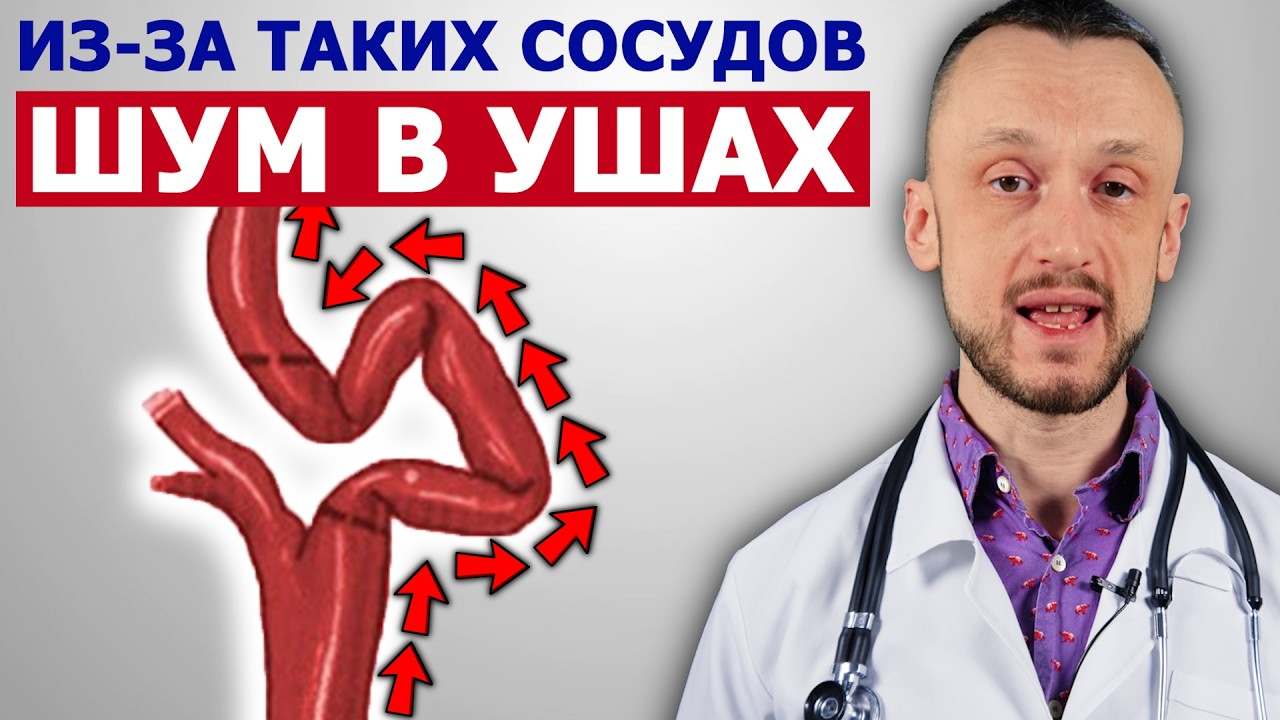 Шум в ушах (в голове) из-за таких сосудов