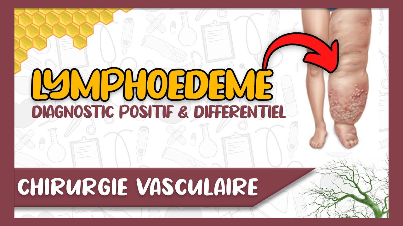 Le Lymphoedème des Membres : Diagnostic clinique, Examens Complémentaires et Diagnostic Différentiel