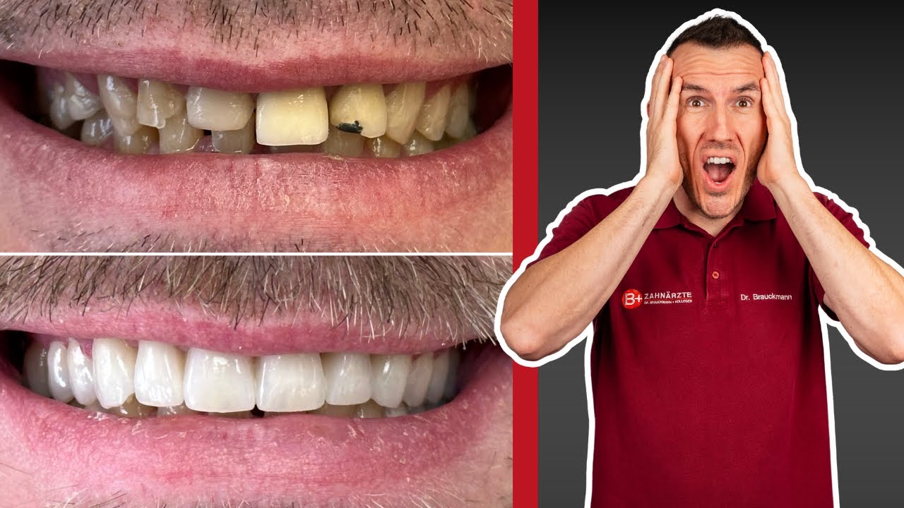 Zähneknirschen durch Zahnkronen loswerden? So helfen dir Kronen bei Bruxismus! Echter Patientenfall!