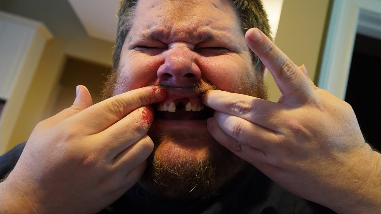 MY TEETH ARE STARTING TO ROT!!