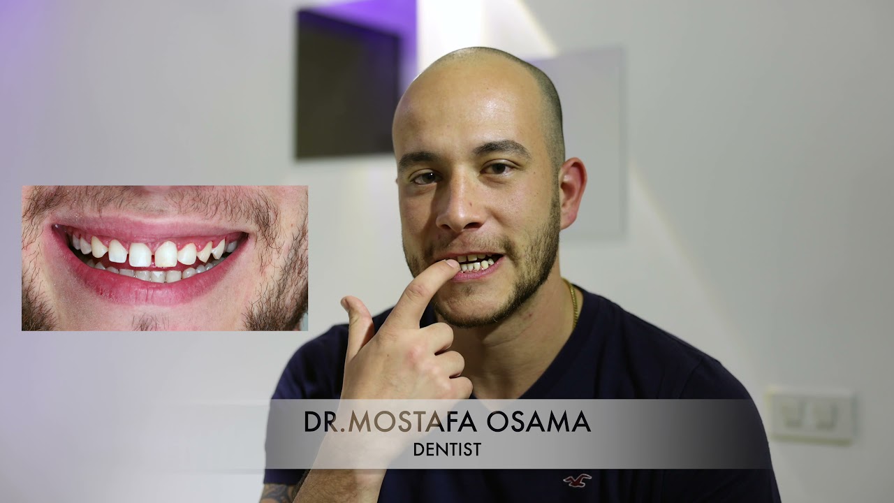 عدسات الاسنان بدون برد الاسنان ، ماذا يحدث بعد ٥ سنوات..