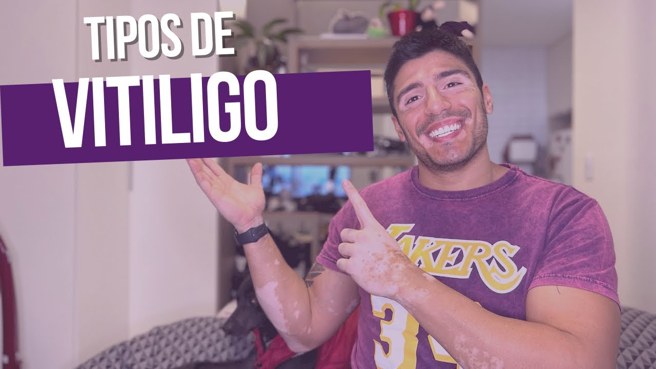 Tipo de Vitiligo 🖤🤍🖤#vitiligo