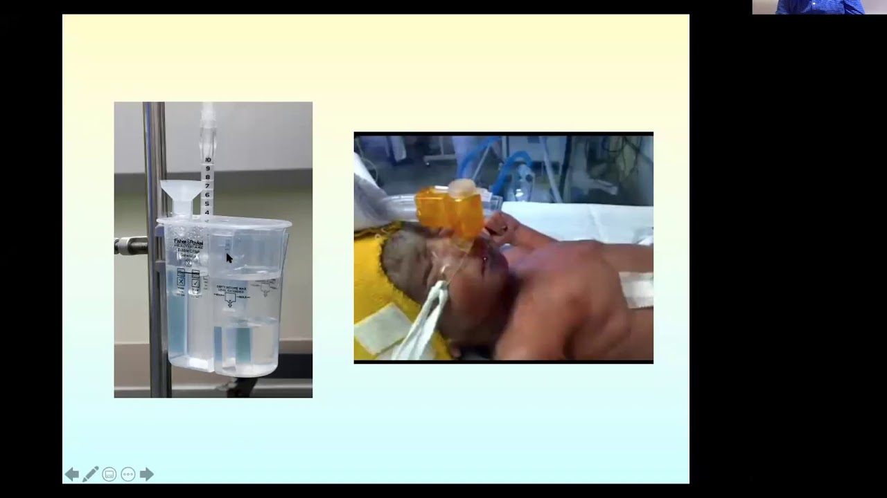 Practice of CPAP