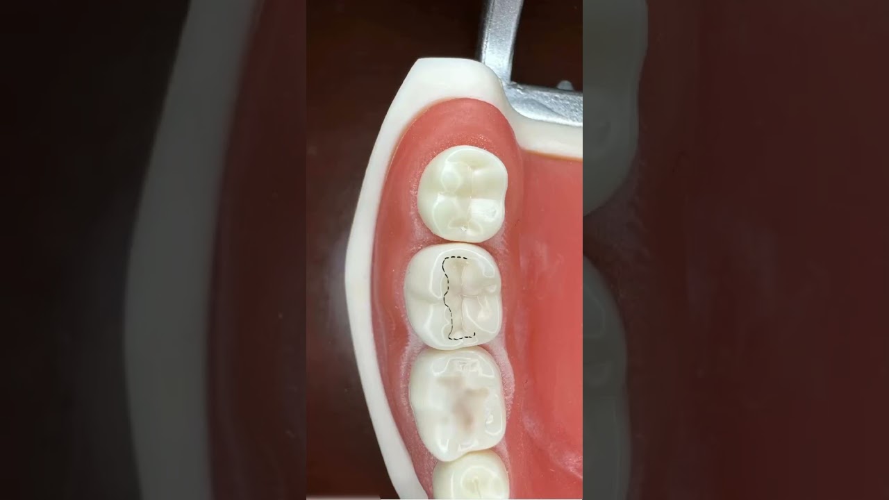 cavity preparation class 1 lower 7
