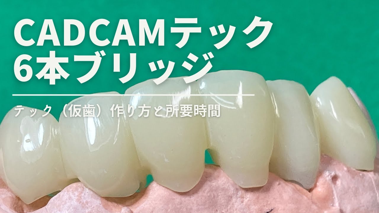 【歯科技工士】テンポラリークラウン（テック）の、歯科用CAD／CAMシステムexocad3.0を使った作り方