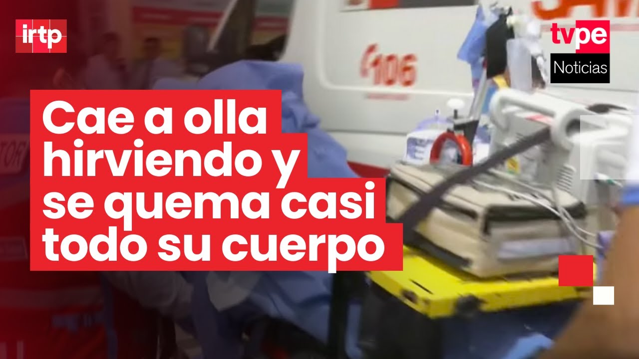 Piura: niño cae accidentalmente a olla con agua hirviendo y resulta con el 80 % de su cuerpo quemado