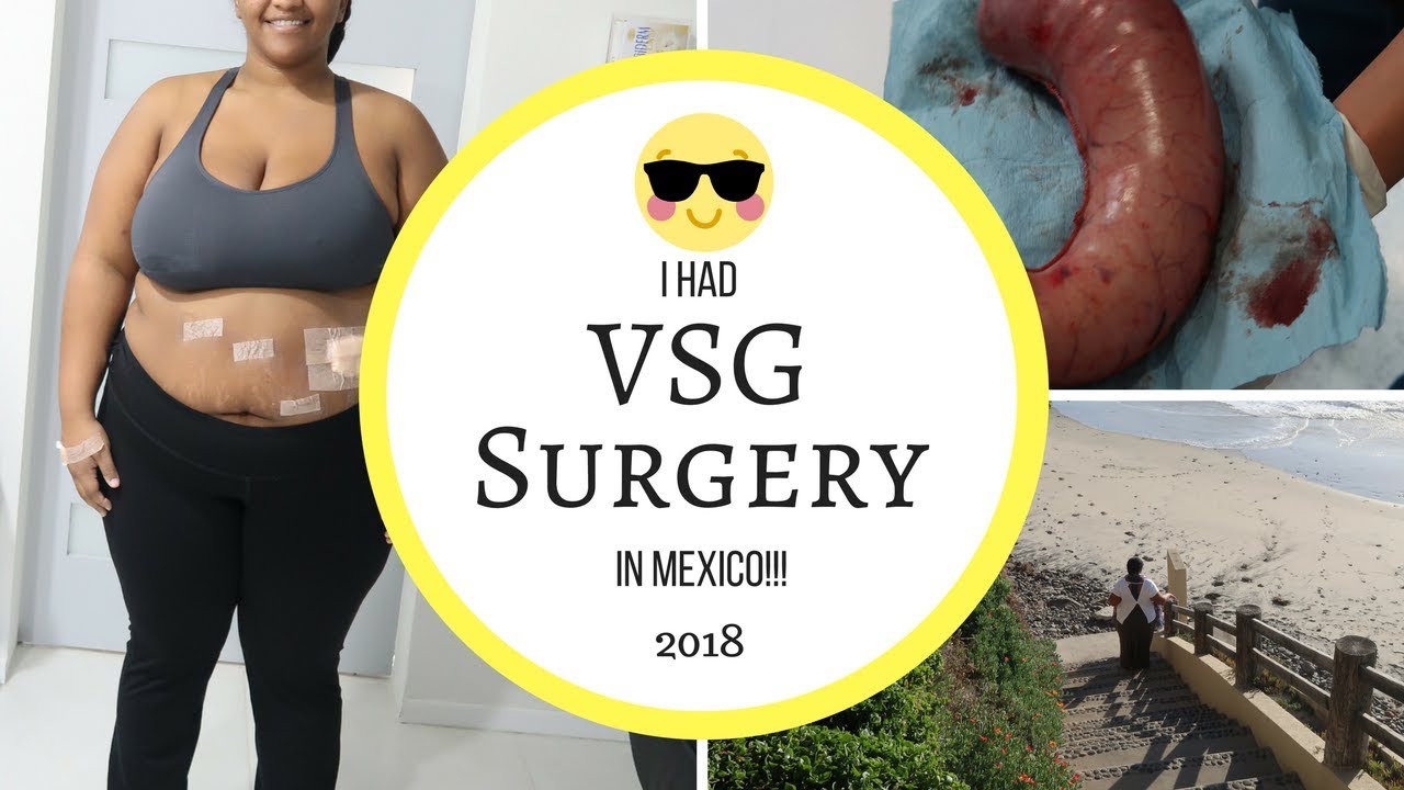 VSG Journey: Vertical Sleeve Gastrectomy in MEXICO