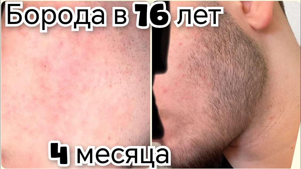 Борода в 16 лет. Средство для роста бороды.  Выпуск 77 Андрей Борода