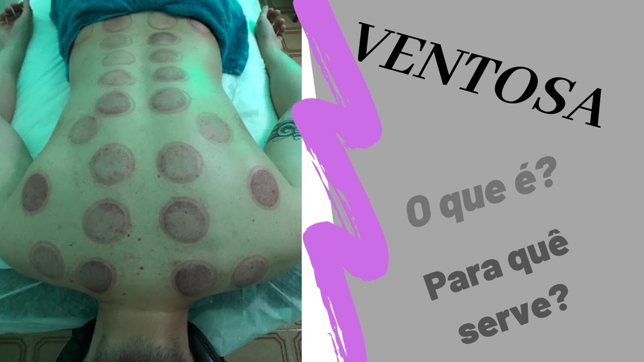 ⚫Ventosaterapia - o que é e para quê serve?