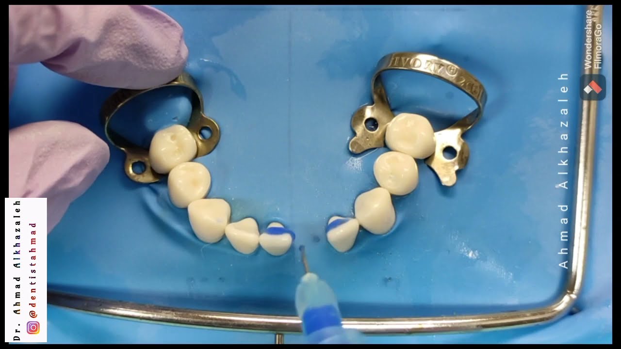 🎇Direct Resin Bonded Bridge! Incisor Replacement with Resin Composite Bridge 🎇