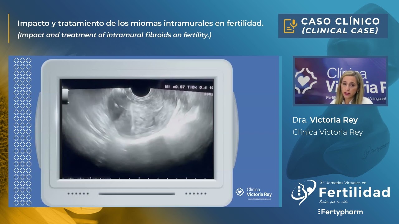 Caso clínico Radiofrecuencia en Fertilidad Dra. Victoria Rey