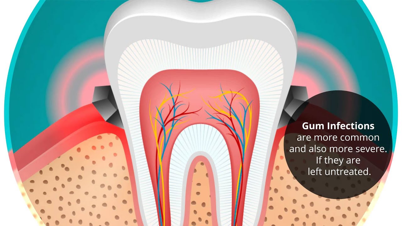 The Effects of Diabetes on Your Teeth