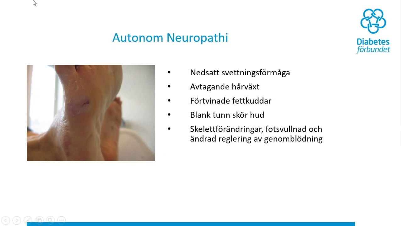 Webbseminarium: Fötter och fotvård