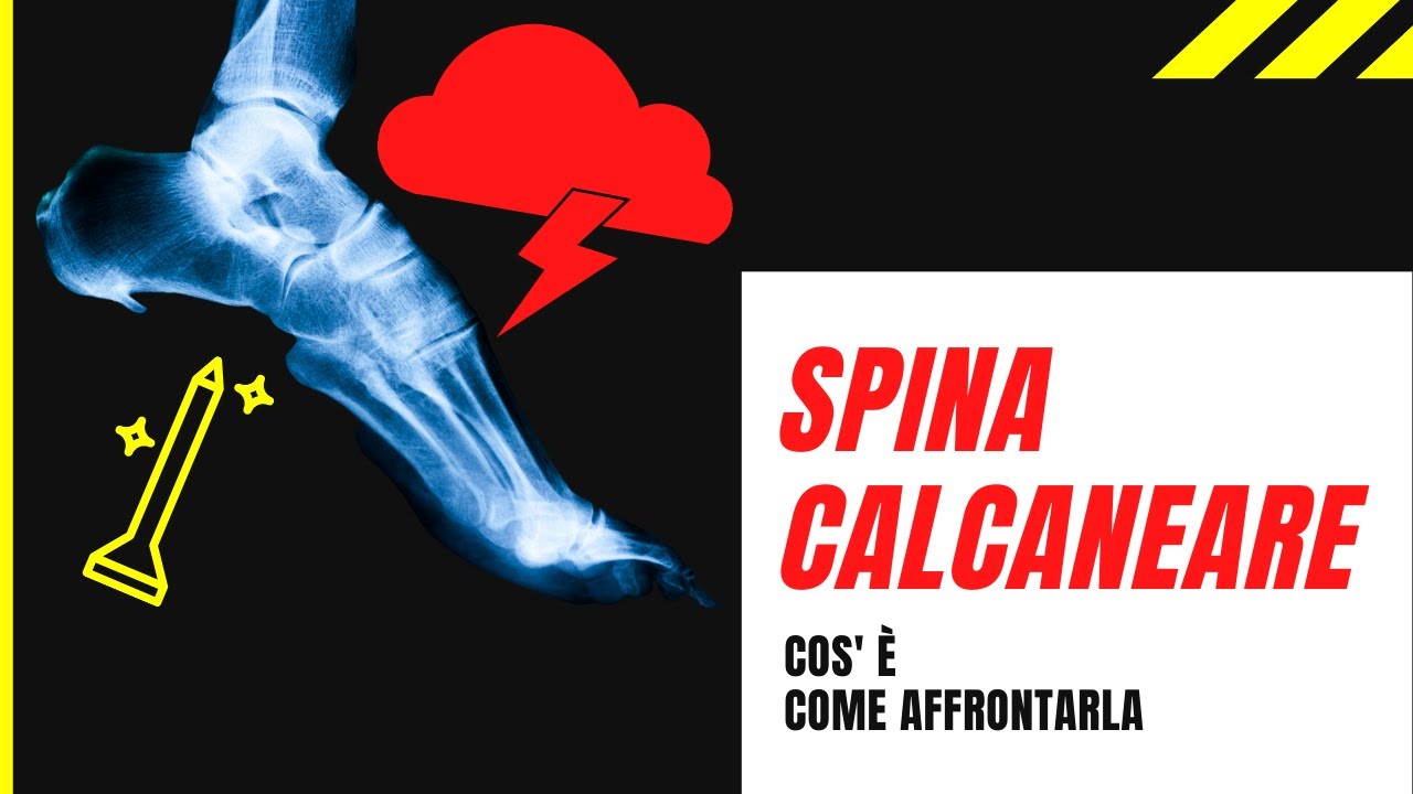 SPINA CALCANEARE: cos'è e come affrontarla