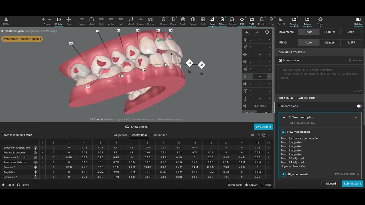 Class I Deep Bite - Invisalign Treatment Planning