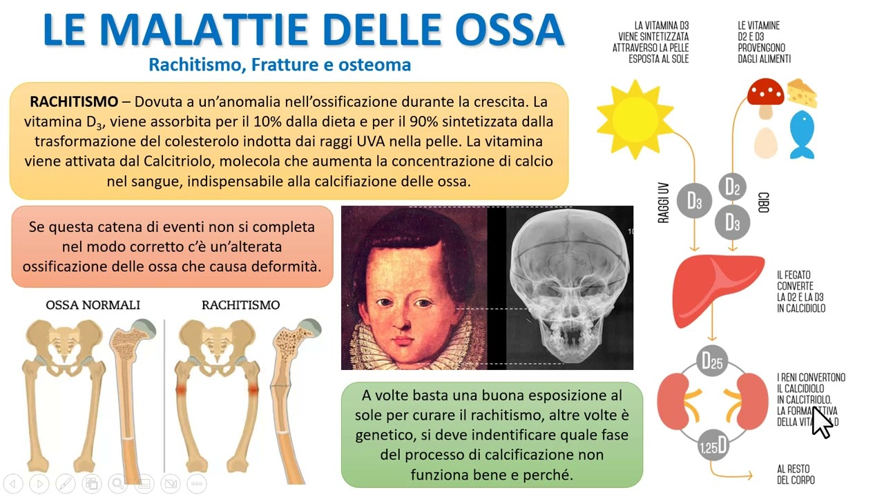 LE PATOLOGIE DELLE OSSA