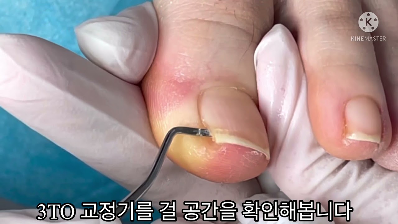 [레푸스 창원상남점] 창원내성발톱 3TO 관리