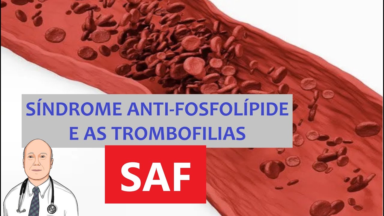 O que é síndrome anti-fosfolípide (SAF) e o que é importante sobre trombofilias