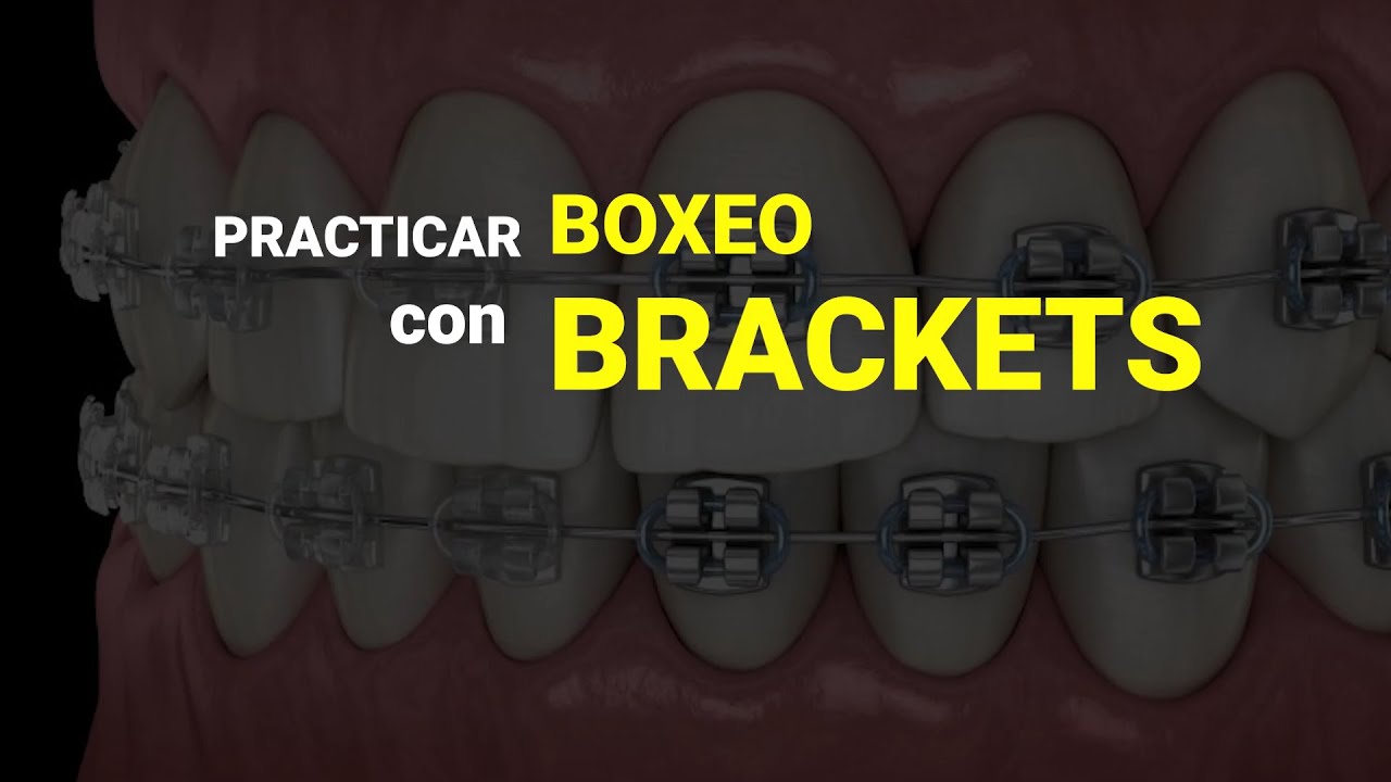 Boxeo con brackets | Qu&eacute; bucal comprar y posibles soluciones