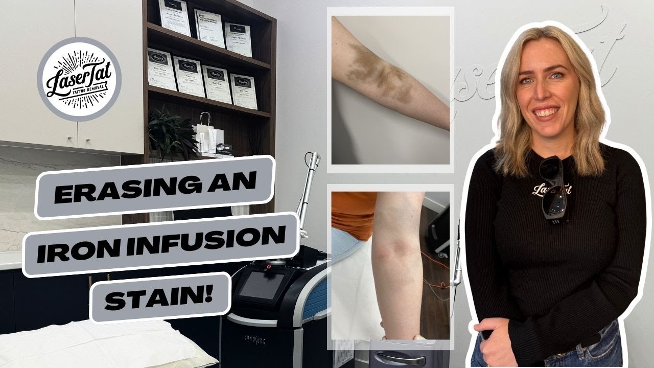 Defying the odds: Our journey to erasing an iron stain with laser tattoo removal at LaserTat.