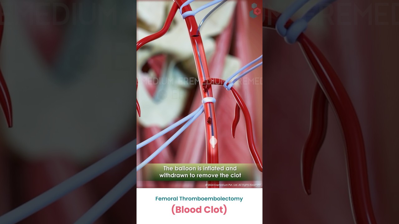 Femoral Thromboembolectomy (Blood Clot) ↪ 3D Medical Animations #BloodClot #Thromboembolectomy