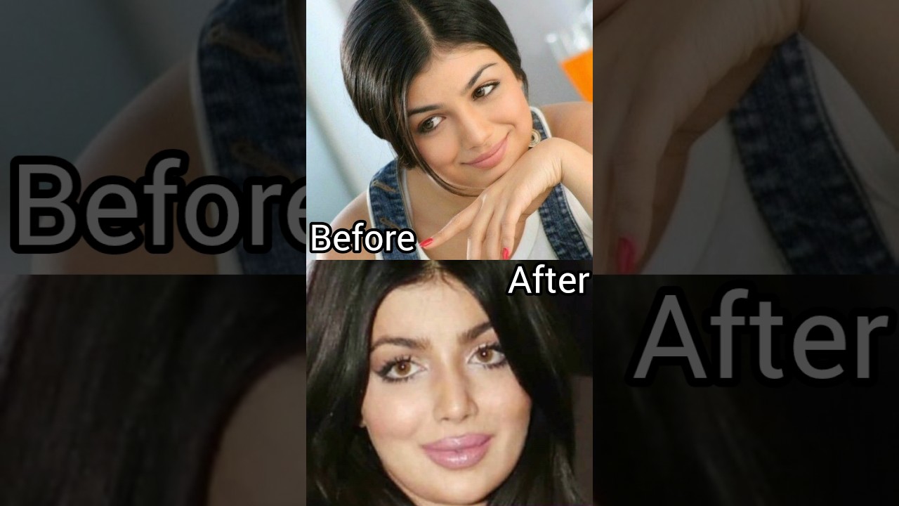 Ayesha Takia Plastic Surgery Ruined Her Face #shorts #ayeshatakia #plasticsurgery