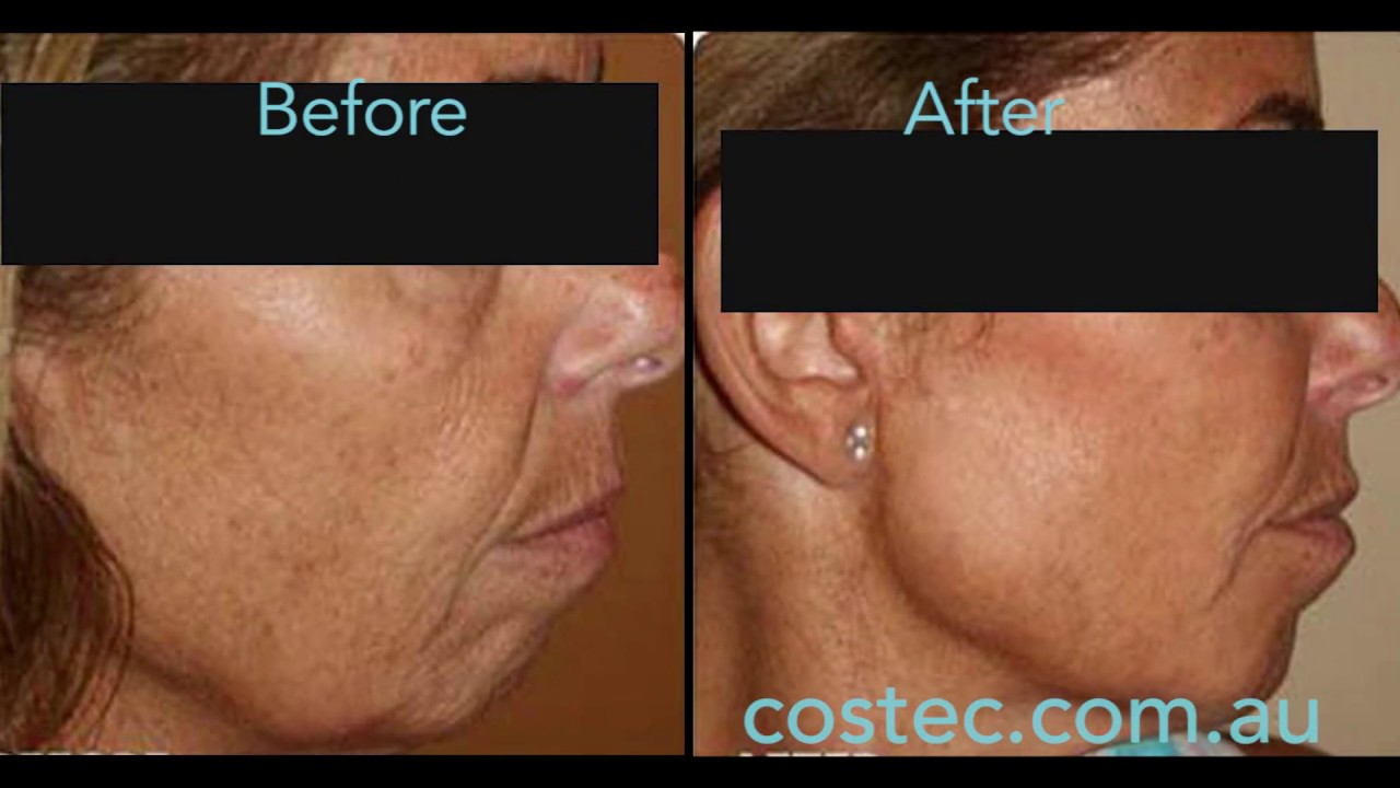 HIFU™ treatment - Before & After pictures for Face Lift and Skin Tightening