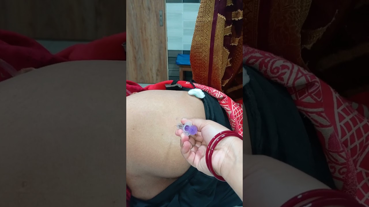 Double side hip injection 