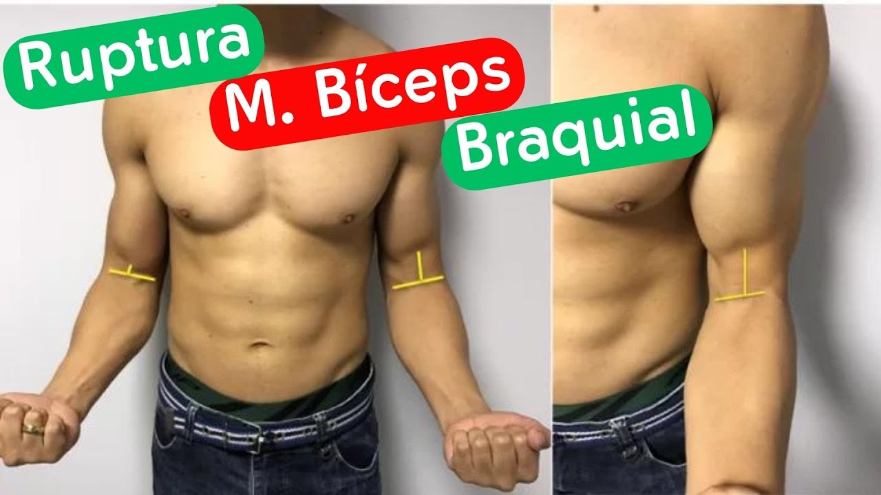 Ruptura Bíceps Braquial - Dr. Prof. Nelson Marques