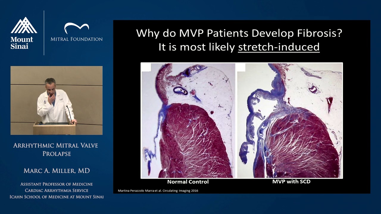 Arrhythmic Mitral Valve Prolapse