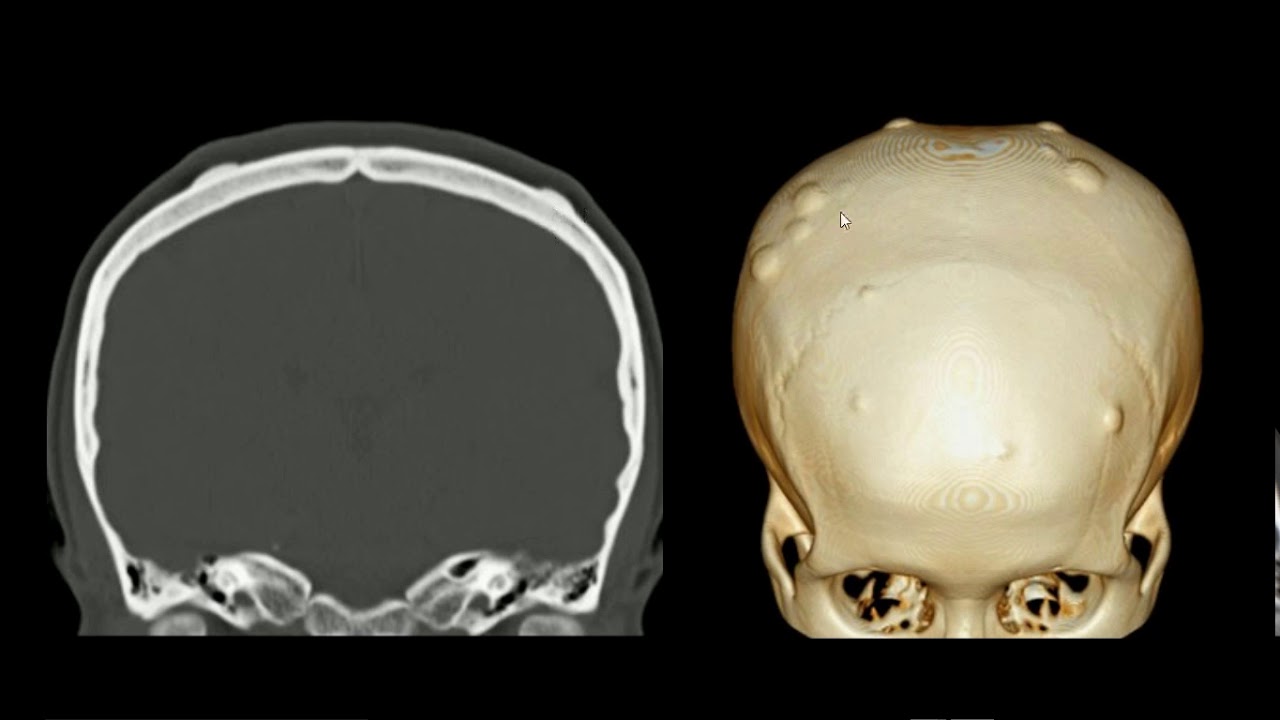 Osteoma